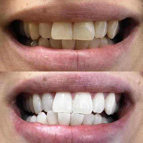 Bandes blanchissantes pour les dents