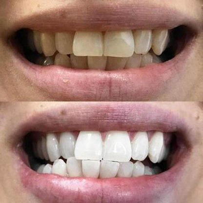 Bandes blanchissantes pour les dents