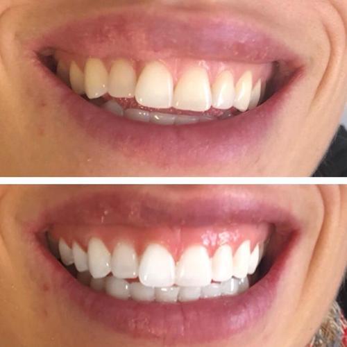 Bandes blanchissantes pour les dents